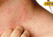 गर्मियों में हो जाती है दाद खाज खुजली, इस देसी नुस्खे से पाएं मुक्ति