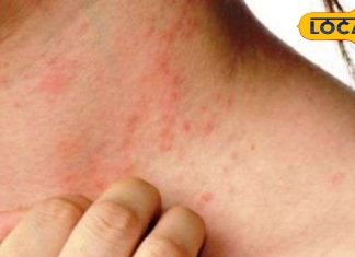 गर्मियों में हो जाती है दाद खाज खुजली, इस देसी नुस्खे से पाएं मुक्ति