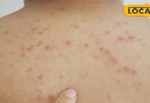 गर्मियों में बार-बार पिंपल्स कर रहे हैं परेशान, तो इन घरेलू उपायों से करें उनकी छुट्टी – Bharat.one हिंदी