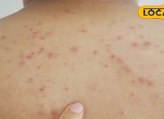 गर्मियों में बार-बार पिंपल्स कर रहे हैं परेशान, तो इन घरेलू उपायों से करें उनकी छुट्टी – Bharat.one हिंदी