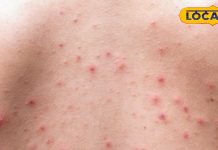 गर्मियों में पिंपल्स कर रहे परेशान, इस घरेलू विधि से पाएं फटाफट मुक्ति – Bharat.one हिंदी