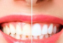 क्या मोतियों जैसे चमकते दांत सेहत के लिए ठीक है? सच्चाई जान हिल जाएंगे आप, अगर ऐसा है तो फिर अलर्ट हो जाएं