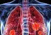 हर 3 हजार में से 1 व्यक्ति को फेफड़ों में छेद का खतरा, इससे किडनी कैंसर का भी जोखिम, वैज्ञानिकों ने पकड़ लिया इसका कारण