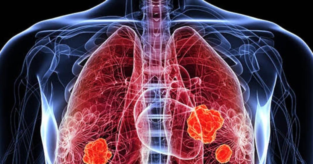 हर 3 हजार में से 1 व्यक्ति को फेफड़ों में छेद का खतरा, इससे किडनी कैंसर का भी जोखिम, वैज्ञानिकों ने पकड़ लिया इसका कारण
