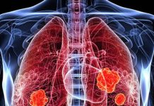 हर 3 हजार में से 1 व्यक्ति को फेफड़ों में छेद का खतरा, इससे किडनी कैंसर का भी जोखिम, वैज्ञानिकों ने पकड़ लिया इसका कारण