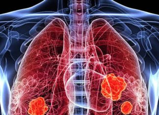 हर 3 हजार में से 1 व्यक्ति को फेफड़ों में छेद का खतरा, इससे किडनी कैंसर का भी जोखिम, वैज्ञानिकों ने पकड़ लिया इसका कारण
