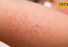 घमौरियों ने कर दिया है परेशान…आजमाएं ये घरेलू नुस्खे, तुरंत मिलेगा ठंडक