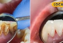 Tips And Tricks: दांतों के दर्द से परेशान…? किचन की ये चीज बनेगी रामबाण इलाज, मिनटों में मिलेगा आराम!