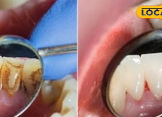 Tips And Tricks: दांतों के दर्द से परेशान…? किचन की ये चीज बनेगी रामबाण इलाज, मिनटों में मिलेगा आराम!