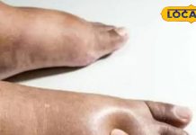 पैर के टखने में बार-बार हो रहा है सूजन, तो किडनी फेल का हो सकता है संकेत