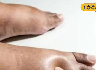 पैर के टखने में बार-बार हो रहा है सूजन, तो किडनी फेल का हो सकता है संकेत