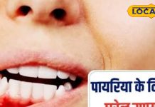 दांतों को खोखला कर देती है ये बीमारी, ऐसे पहचानें शुरुआती संकेत, एक्सपर्ट से जानें घरेलू इलाज