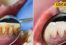 Pyorrhea Remedies: दांतों में लगे पायरिया को जड़ कर देती हैं ये सस्ती चीजें, ज्यादातर तो हैं आपके किचन में मौजूद – Uttarakhand News