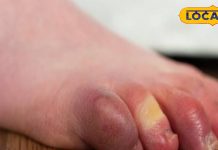 गठिया में यूरिक एसिड: डॉ सिराज सिद्दीकी की प्यूरीन डाइट सलाह