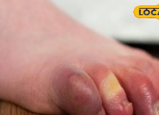 गठिया में यूरिक एसिड: डॉ सिराज सिद्दीकी की प्यूरीन डाइट सलाह