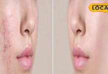 चेहरे के दाग-धब्बों से हैं परेशान, अपनाएं ये आसान और सस्ता उपाय, 20 साल पुराना पिगमेंटेशन भी होगा खत्म