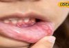 Health Tips: मुंह के छालों से हैं परेशान, इन घरेलू नुस्खों को करें ट्राई, झटपट मिल जाएगा आराम