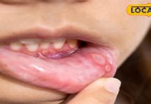Health Tips: मुंह के छालों से हैं परेशान, इन घरेलू नुस्खों को करें ट्राई, झटपट मिल जाएगा आराम