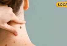 Health Tips: मस्सों को हटाने के लिए अपनाएं ये घरेलू नुस्खे, चंद दिनों में हो जाएंगे गायब