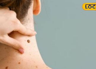 Health Tips: मस्सों को हटाने के लिए अपनाएं ये घरेलू नुस्खे, चंद दिनों में हो जाएंगे गायब