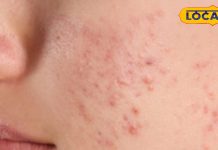 चेहरे की हर समस्या का हल नाभि में, रोज बस 5 बूँद लगाइए तिल या नारियल तेल, सिर्फ 7 दिन में आएगा कुदरती ग्लो