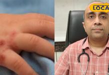 बच्चों में तेजी से फैल रही हैंड, फुट और माउथ बीमारी: लक्षण व बचाव