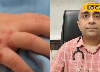 बच्चों में तेजी से फैल रही हैंड, फुट और माउथ बीमारी: लक्षण व बचाव