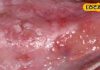 Oral Cancer Symptoms: निमाड़वासियों के लिए साइलेंट किलर बना ओरल कैंसर, एक्सपर्ट से जानें लक्ष्ण और बचाव के उपाय