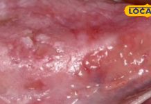 Oral Cancer Symptoms: निमाड़वासियों के लिए साइलेंट किलर बना ओरल कैंसर, एक्सपर्ट से जानें लक्ष्ण और बचाव के उपाय