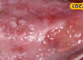 Oral Cancer Symptoms: निमाड़वासियों के लिए साइलेंट किलर बना ओरल कैंसर, एक्सपर्ट से जानें लक्ष्ण और बचाव के उपाय