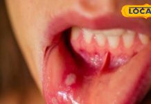 मुंह के छालों ने खाना-पीना कर दिया है मुश्किल, अपनाएं दादी-नानी के नुस्खे, जल्दी मिलेगा आराम