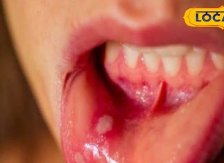 मुंह के छालों ने खाना-पीना कर दिया है मुश्किल, अपनाएं दादी-नानी के नुस्खे, जल्दी मिलेगा आराम