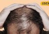 Hair Fall Causes: शैंपू और तेल लगाने में आप भी कर रहे हैं यह गलती, तो बहुत जल्द झड़ जाएंगे सारे बाल, अपनाएं ये घरेलू नुस्खा
