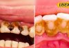 Rotten Tooth Treatment | 5 Dentist Tips Root Cleaning