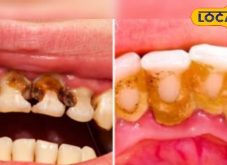 Rotten Tooth Treatment | 5 Dentist Tips Root Cleaning