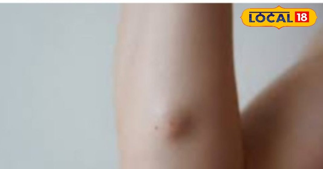 Lipoma Treatment: न महंगी दवा और न सर्जरी, इन घरेलू उपायों से दूर करें लिपोमा के गांठ