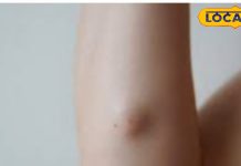 Lipoma Treatment: न महंगी दवा और न सर्जरी, इन घरेलू उपायों से दूर करें लिपोमा के गांठ