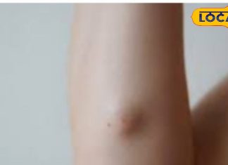 Lipoma Treatment: न महंगी दवा और न सर्जरी, इन घरेलू उपायों से दूर करें लिपोमा के गांठ