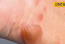 Tomato Flu: वायरल फीवर के बीच तेजी से फैल रहा ‘टोमेटो फ्लू’, बच्चों पर मंडरा रहा नया खतरा!