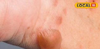 Tomato Flu: वायरल फीवर के बीच तेजी से फैल रहा ‘टोमेटो फ्लू’, बच्चों पर मंडरा रहा नया खतरा!