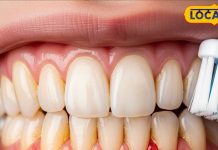 Dental Care: दांतों की सेहत के लिए जरूरी हैं ये विटामिन्स! डॉक्टर से जानें किन फलों से दूर होगी डेंटल प्रॉब्लम – Uttar Pradesh News