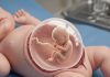 Rare Case Two Fetuses Found Inside Baby in Gurugram | गुरुग्राम में एक महीने की बच्ची के पेट से निकाले गए जुड़वां भ्रूण