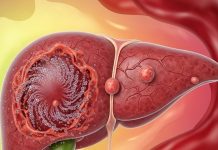 Hepatitis A and E Cases Rising in Delhi Know Prevention Tips | दिल्ली में बढ़े हेपेटाइटिस A और E के मामले, जानें कैसे करें बचाव