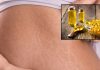 Does Fish Oil Remove Strech Marks। स्ट्रेच मार्क्स कम करने के लिए फिश ऑयल के फायदे और इस्तेमाल के तरीके.