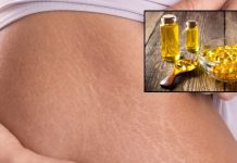 Does Fish Oil Remove Strech Marks। स्ट्रेच मार्क्स कम करने के लिए फिश ऑयल के फायदे और इस्तेमाल के तरीके.