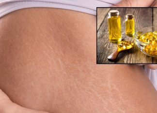Does Fish Oil Remove Strech Marks। स्ट्रेच मार्क्स कम करने के लिए फिश ऑयल के फायदे और इस्तेमाल के तरीके.