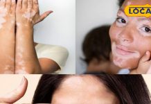Vitiligo Treatment: सफेद दाग से हैं परेशान, तो भोपाल के वैध जी करेंगे जड़ी-बूटियों से इलाज..सिर्फ 10 दिन में दिखेगा असर