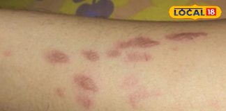 Health Tips: किचन का चमत्कार… घरेलू नुस्खों से हटाएं शरीर के जले के निशान, डाक्टर भी कहेंगे वाह!