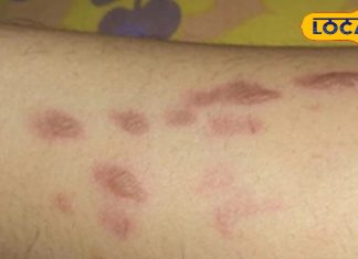 Health Tips: किचन का चमत्कार… घरेलू नुस्खों से हटाएं शरीर के जले के निशान, डाक्टर भी कहेंगे वाह!