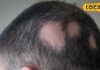 बाल झड़ने लगे हैं तेज़ी से? यह बीमारी हो सकती है जिम्मेदार, जानें बचाव के कुछ जरूरी उपाय – Uttar Pradesh News